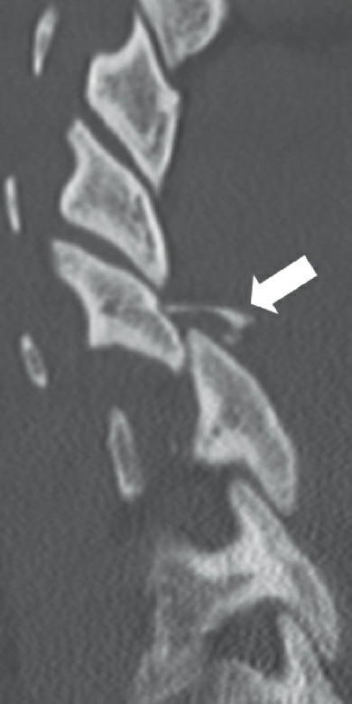 Fonte: Rockwood and Green's Fractures in Adults, 10ª ed., capítulo 48, figura 48-13.