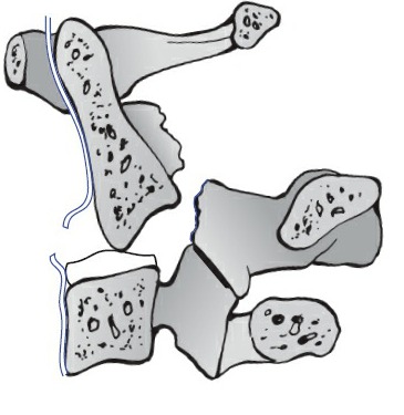 Fonte: Rockwood and Green's Fractures in Adults, 10ª ed., capítulo 48, figura 48-40.