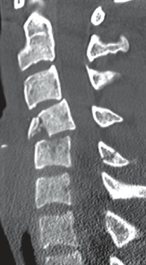Fonte: Rockwood and Green's Fractures in Adults, 10ª ed., capítulo 48, figura 48-51.