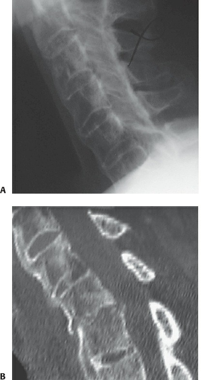 Fonte: Rockwood and Green's Fractures in Adults, 10ª ed., capítulo 48, figura 48-56.