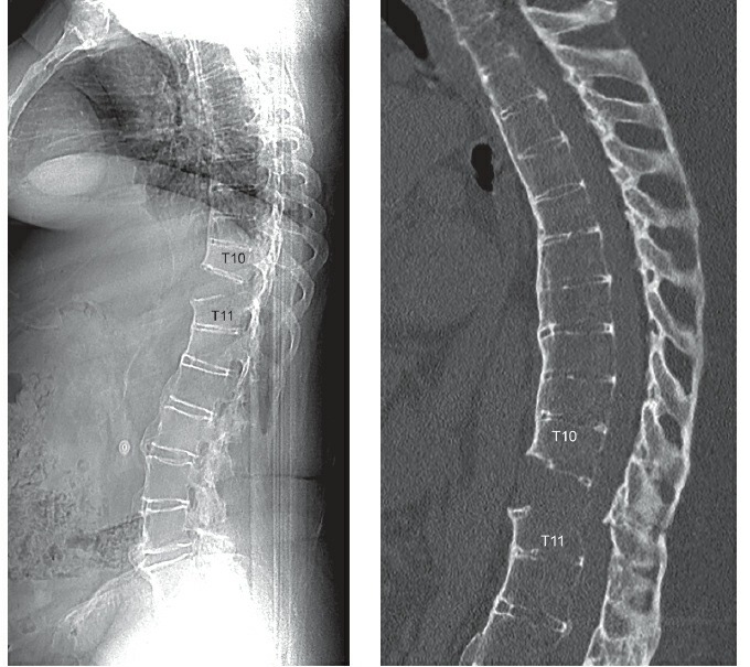 Fonte: Rockwood and Green's Fractures in Adults, 10ª ed., capítulo 49, figura 49-29A e B.