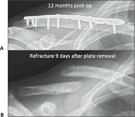 Fonte: Rockwood and Green's Fractures in Adults, 10ª ed., capítulo 1, figura 1-17.