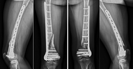 Fonte: Rockwood and Green's Fractures in Adults, 10ª ed., capítulo 1, figura 1-19.