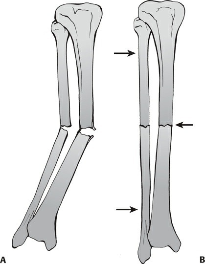 Fonte: Rockwood and Green's Fractures in Adults, 10ª ed., capítulo 10, figura 10-7.