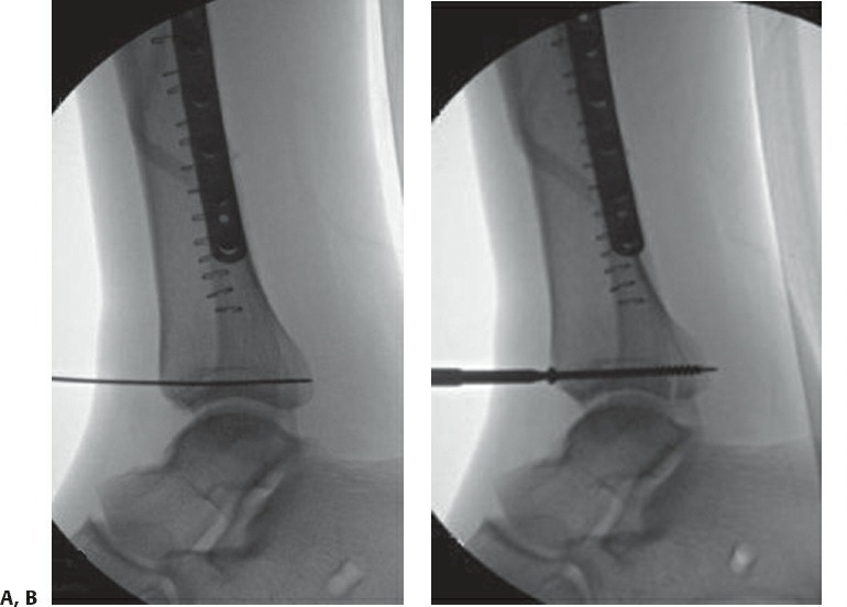 Fonte: Rockwood and Green's Fractures in Adults, 10ª ed., capítulo 12, figura 12-7A e B.
