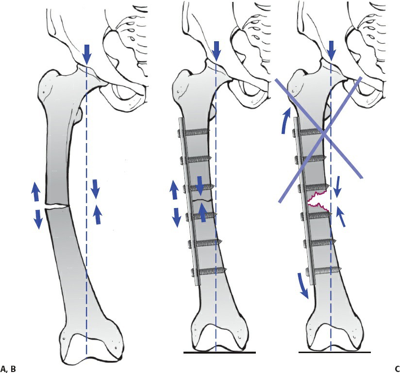 Fonte: Rockwood and Green's Fractures in Adults, 10ª ed., capítulo 12, figura 12-18.