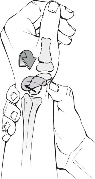 Fonte: Rockwood and Green's Fractures in Adults, 10ª ed., capítulo 44, figura 44-9.