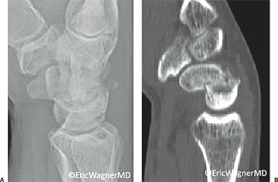 Fonte: Rockwood and Green's Fractures in Adults, 10ª ed., capítulo 44, figura 44-28.