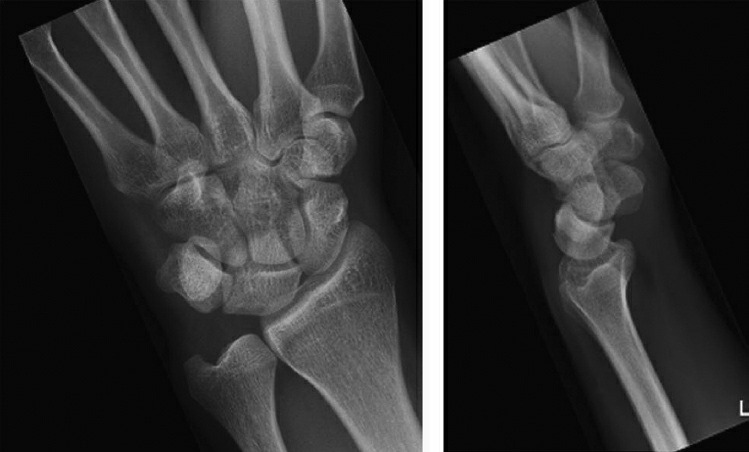 Fonte: Rockwood and Green's Fractures in Adults, 10ª ed., capítulo 44, figura 44-43.