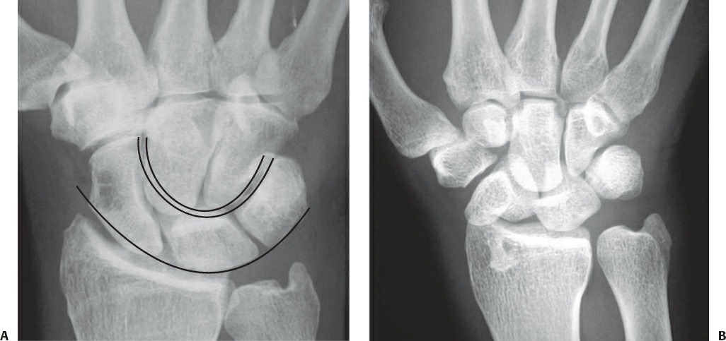 Fonte: Rockwood and Green's Fractures in Adults, 10ª ed., capítulo 44, figura 44-12.