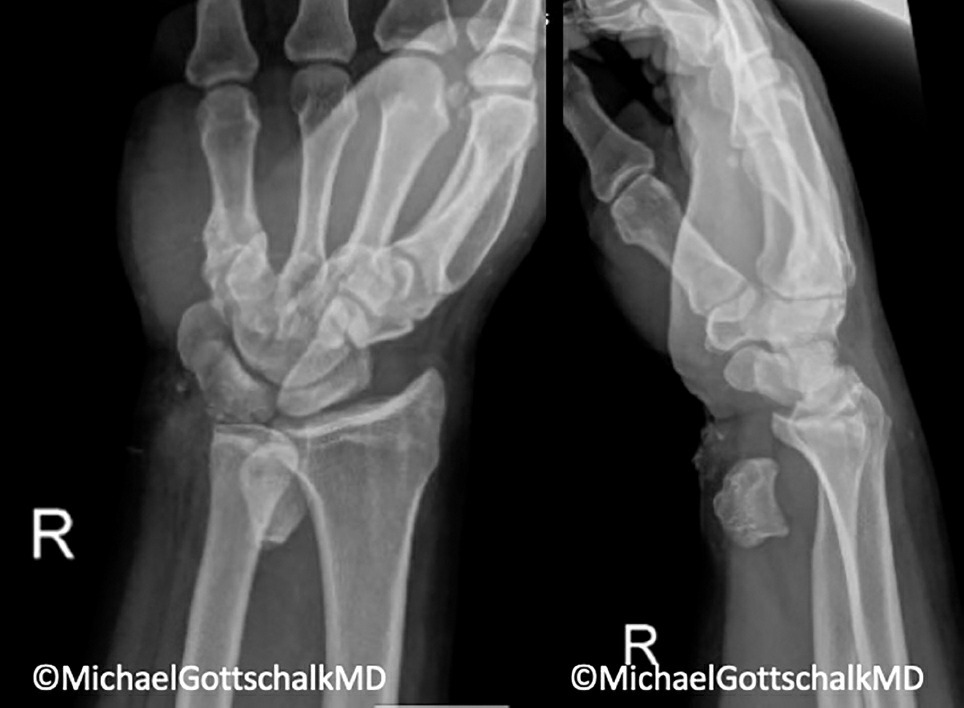 Fonte: Rockwood and Green's Fractures in Adults, 10ª ed., capítulo 44, figura 44-36.