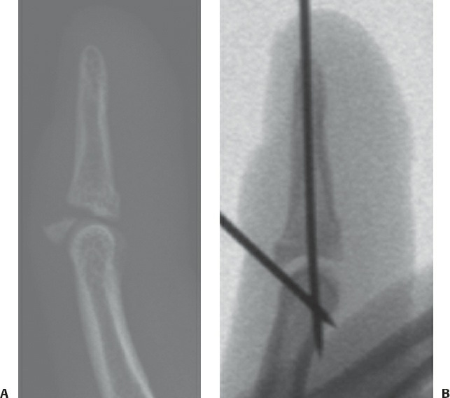 Fonte: Rockwood and Green's Fractures in Adults, 10ª ed., capítulo 45, figura 45-6.