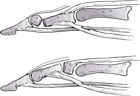 Fonte: Rockwood and Green's Fractures in Adults, 10ª ed., capítulo 45, figura 45-10.