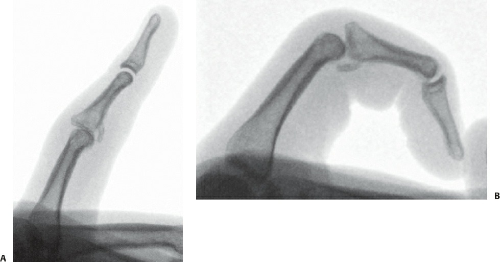 Fonte: Rockwood and Green's Fractures in Adults, 10ª ed., capítulo 45, figura 45-8.
