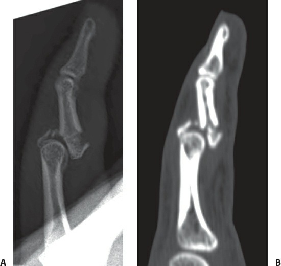 Fonte: Rockwood and Green's Fractures in Adults, 10ª ed., capítulo 45, figura 45-23.