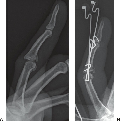 Fonte: Rockwood and Green's Fractures in Adults, 10ª ed., capítulo 45, figura 45-28.