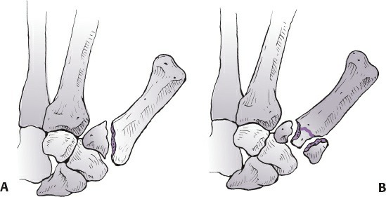 Fonte: Rockwood and Green's Fractures in Adults, 10ª ed., capítulo 45, figura 45-69.