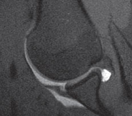 Fonte: AZAR, F. M.; BEATY, J. H. Campbell’s operative orthopaedics. 14. ed. Philadelphia: