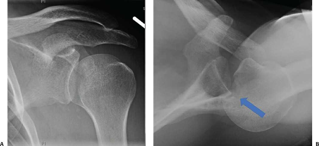 Fonte: Rockwood and Green's Fractures in Adults, 10ª ed., capítulo 35, figura 35-5.
