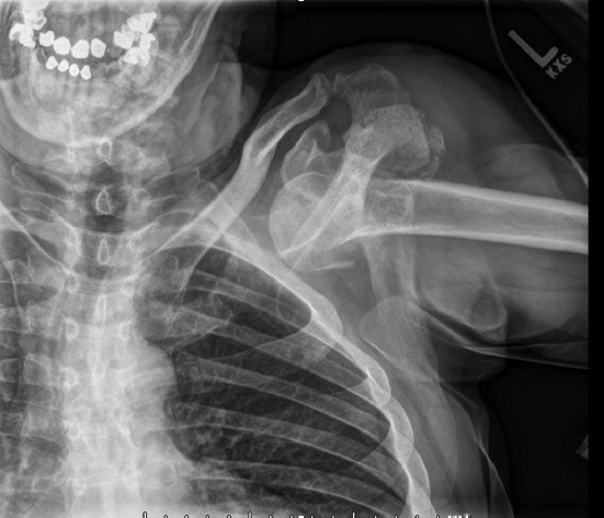 Fonte: Rockwood and Green's Fractures in Adults, 10ª ed., capítulo 35, figura 35-2.