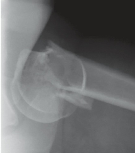 Fonte: Rockwood and Green's Fractures in Adults, 10ª ed., capítulo 36, figura 36-22A.