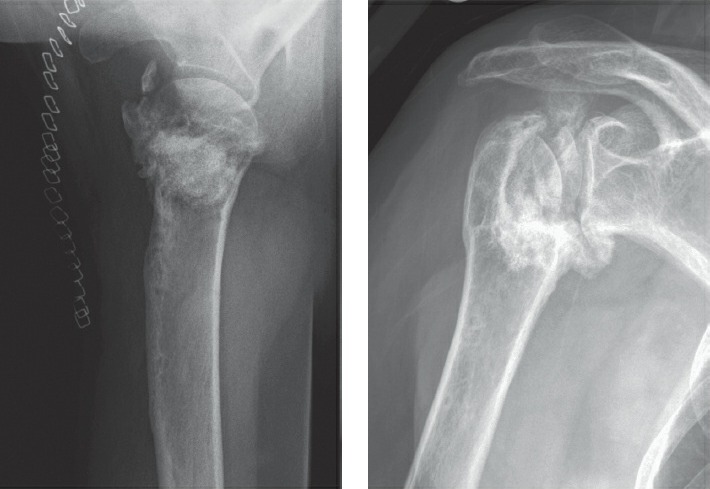 Fonte: Rockwood and Green's Fractures in Adults, 10ª ed., capítulo 36, figura 36-51O e P.