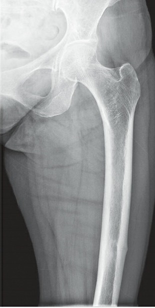 Fonte: Rockwood and Green's Fractures in Adults, 10ª ed., capítulo 4, figura 4-4B.