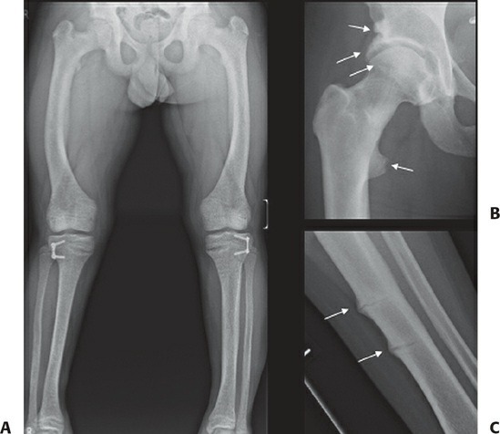 Fonte: Rockwood and Green's Fractures in Adults, 10ª ed., capítulo 4, figura 4-7.