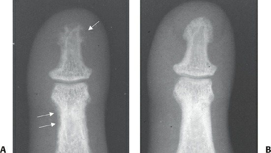 Fonte: Rockwood and Green's Fractures in Adults, 10ª ed., capítulo 4, figura 4-8.