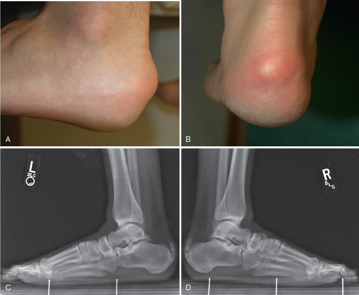 Fonte: AZAR, F. M.; BEATY, J. H. Campbell’s operative orthopaedics. 14. ed. Philadelphia: