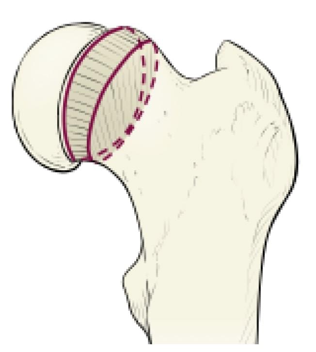 Fonte: HERRING, J. A. Tachdjian’s pediatric orthopaedics. 6.ed. Philadelphia: Elsevier, 2022.