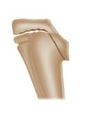 Fonte: WEINSTEIN, S. L.; FLYNN, J. M. Lovell and Winter’s pediatric orthopaedics. 8. ed.