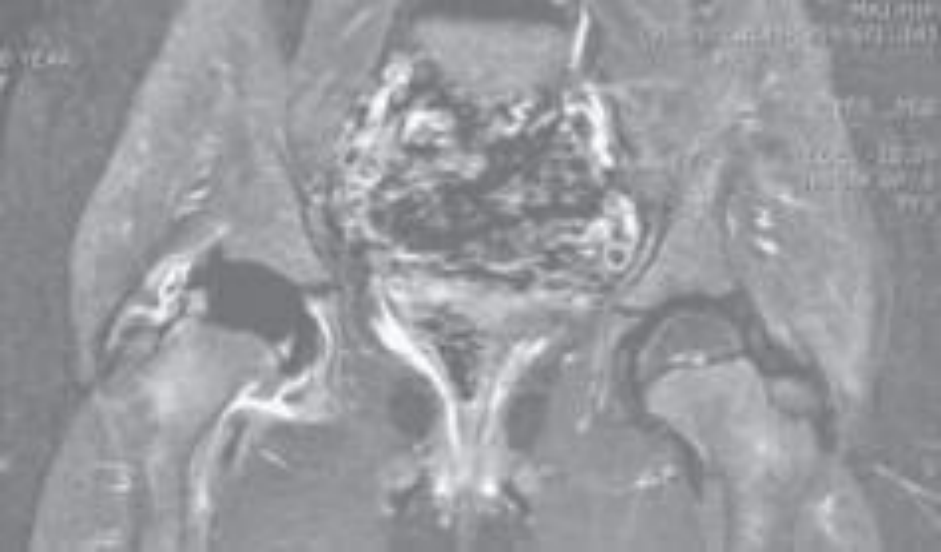 Fonte: HERRING, J. A. Tachdjian’s pediatric orthopaedics. 6. ed. Philadelphia: Elsevier, 2022.