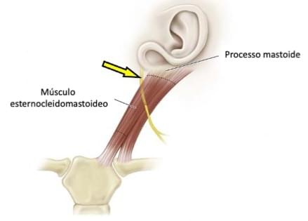 Fonte: HERRING, J. A. Tachdjian’s pediatric orthopaedics. 6. ed. Philadelphia: Elsevier, 2022.