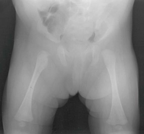 Fonte: WEINSTEIN, S. L.; FLYNN, J. M. Lovell and Winter’s pediatric orthopaedics. 8. ed.