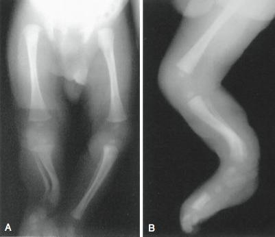 Fonte: HERRING, J. A. Tachdjian’s pediatric orthopaedics. 6. ed. Philadelphia: Elsevier, 2022.