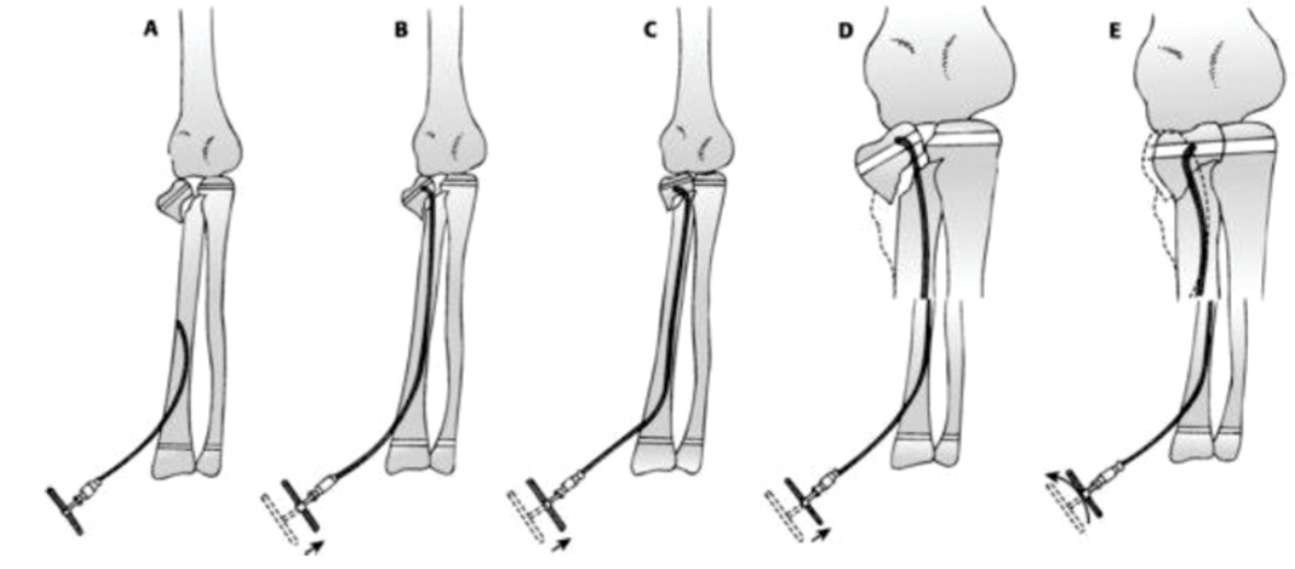 Fonte: WATERS, P. M.; SKAGGS, D. L.; FLYNN, J. M. Rockwood and Wilkins’ Fractures in Children. 9. ed. Philadelphia: Wolters Kluwer, 2020.