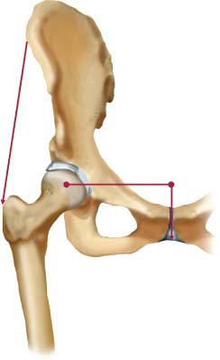Fonte: The Adult Hip (Callaghan), 3ª ed., Figura 10.3.