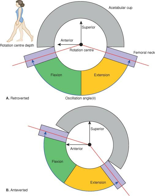 Fonte: The Adult Hip (Callaghan), 3ª ed., Figura 11.11.