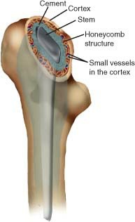 Fonte: The Adult Hip (Callaghan), 3ª ed., Figura 16.12.