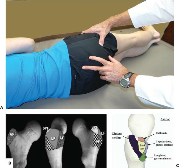 Fonte: The Adult Hip (Callaghan), 3ª ed., Figura 22.21.