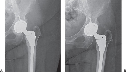 Fonte: The Adult Hip (Callaghan), 3ª ed., Figura 23.26.