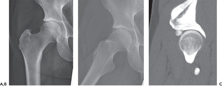Fonte: The Adult Hip (Callaghan), 3ª ed., Figura 23.31.
