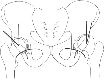 Fonte: The Adult Hip (Callaghan), 3ª ed., Figura 23.34.