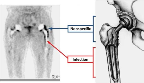 Fonte: The Adult Hip (Callaghan), 3ª ed., Figura 24.8.