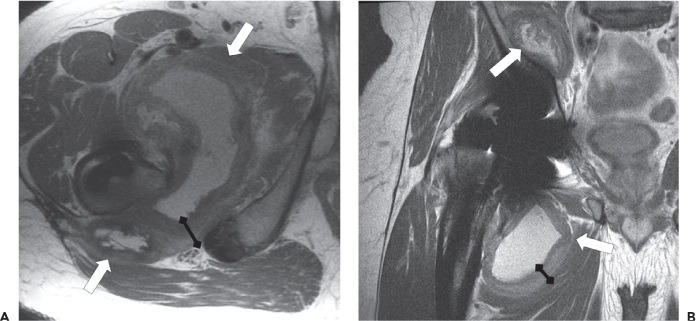 Fonte: The Adult Hip (Callaghan), 3ª ed., Figura 25.12.