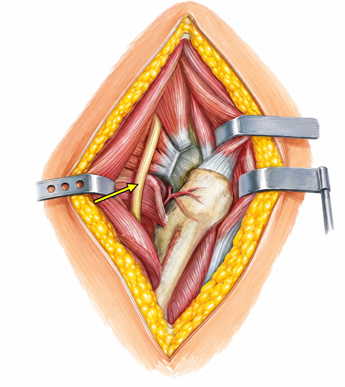 Fonte: Netter, Atlas de Anatomia Ortopédica, 2ª edição.