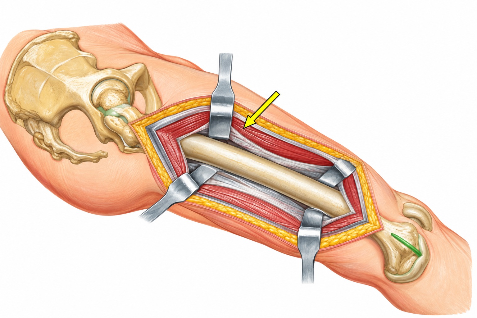 Fonte: Netter, Atlas de Anatomia Ortopédica, 2ª edição.