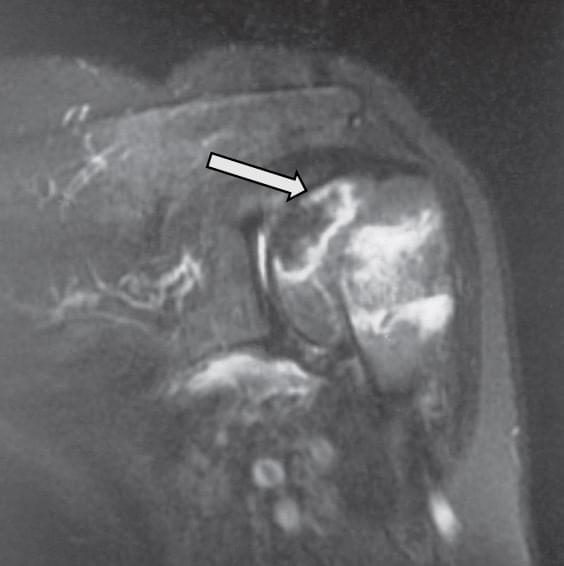 Fonte: AZAR, F. M.; BEATY, J. H. Campbell’s operative orthopaedics. 14. ed.Philadelphia: