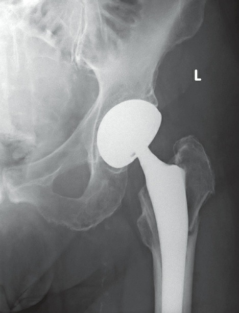 Fonte: Rockwood and Green's Fractures in Adults, 10ª ed., capítulo 10, figura 10-53.
